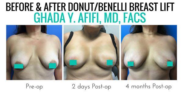 Breast Augmentation Santa Ana, CA