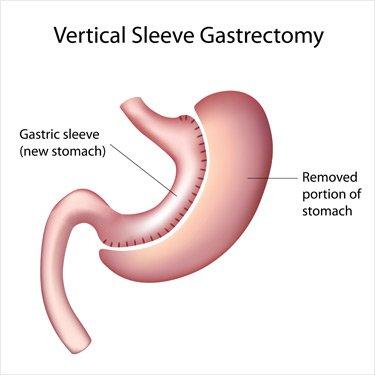 Gastric Sleeve