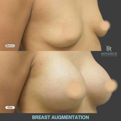 High Profile Silicone Breast Implants