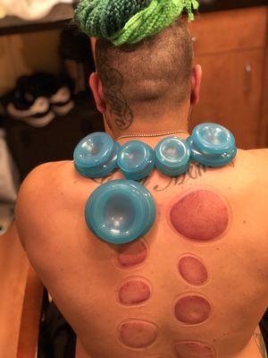 Cupping Therapy