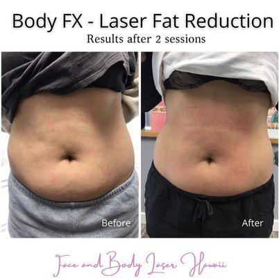 Body FX Laser Fat Reduction (two sessions)