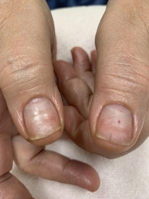 Damage after 4 months of powder dip manicure at Pearl Nails in Carlsbad. Notice the top half of split and paper thin nails.