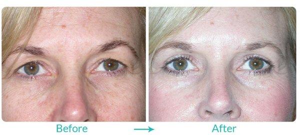 Before and After Upper Blepharoplasty (Upper Eyelid Lift) by Dr. Steven C. Dresner