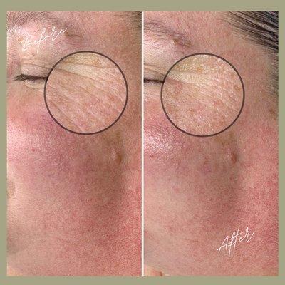 Improvement in crows feet after 1 DMK Enzyme Service.