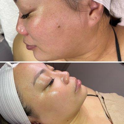 O2 Lift + Dermaplaning by Jamie