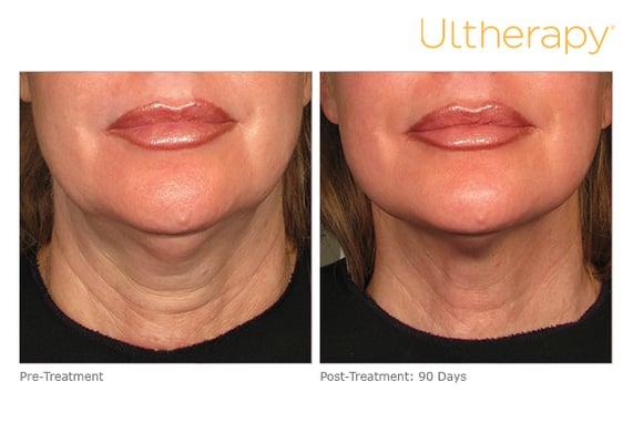 The Laser Center offers the Ultherapy Treatment - the only non-invasive procedure FDA-approved to lift the Neck, Chin and Brow.