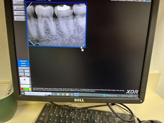 Dental  X-ray