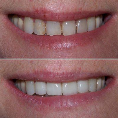 Michelle wanted a natural, yet healthier, looking smile. It was an honor to help her achieve her goals!