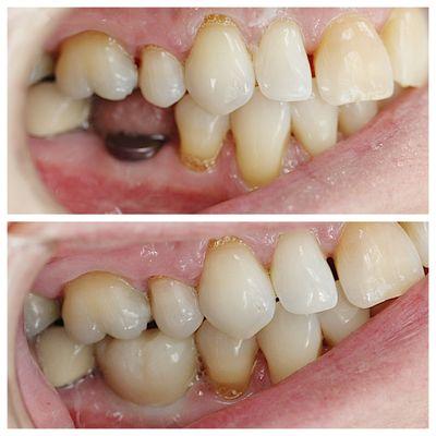 Implant and All Zirconia Implant crown