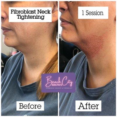 Noninvasive Neck lift! Plasma fibroblast