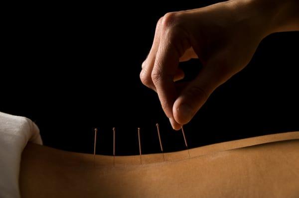 Acupuncture, Five Phases Acupuncture PC, Needle, Needle Technique, De-Qi