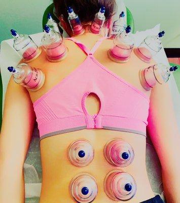 Cupping!