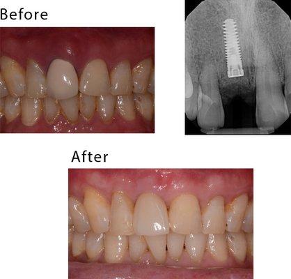 Patient had a periodontal infection and lost his front tooth. It was removed and restored with an implant-supported ceramic crown.