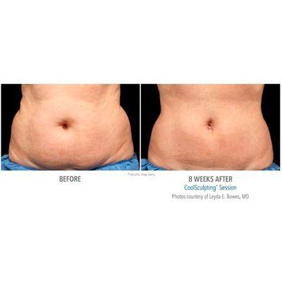 CoolSculpting Elite in Nashville, TN