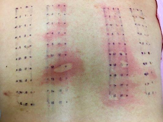 The results on my back read, "Spring will be the death of me." Lol! Allergic to grass, weeds, trees, etc.