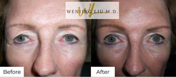 Brow lift and upper eyelid lift (blepharoplasty)