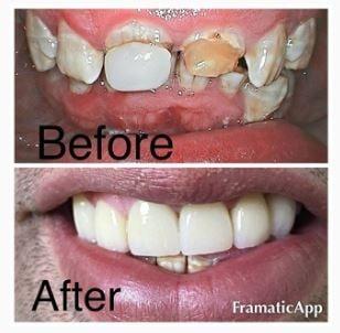 Smile makeover with just 6 restorations. (bottom teeth still in process)