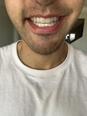 Month 7 of Invisalign