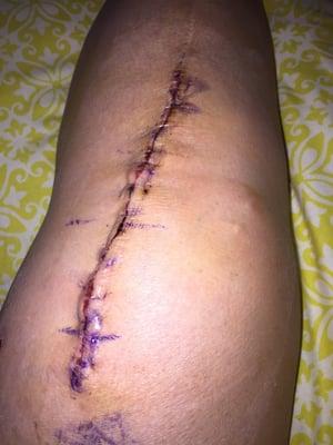 Left knee allograft- best decision of my life.