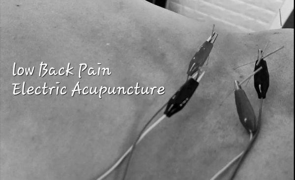 Low back pain
 Electric Acupuncture
 Best Acupuncturist