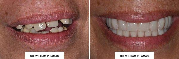 All-on-4 Dental Implants Before & After Photo - William P. Lamas, DMD - Periodontics & Dental Implants...