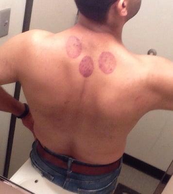 Cupping