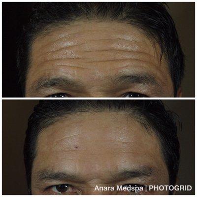 Botox for forehead in a man at Anara