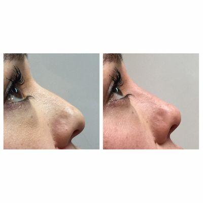 Juvederm used to enhance the nose .