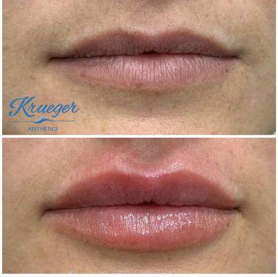 Lip Fillers