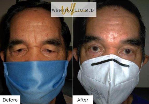 Brow lift and upper eyelid lift (blepharoplasty)