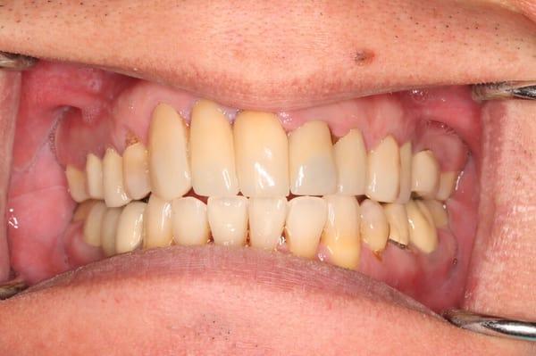 Emax restorations, Progressive Orthodontics and a great patient!