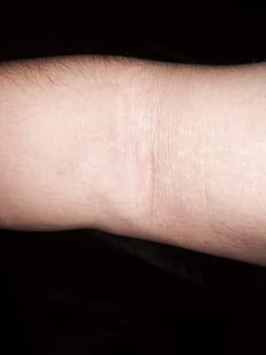 The scar is barely visible from surgery now. No staples or suture lines.