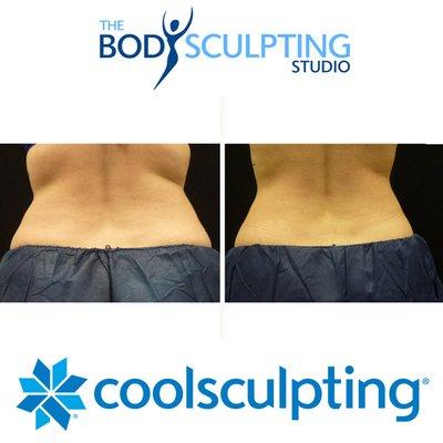 Get rid of your unwanted diet and exercise resistant fat with CoolSculpting at The Body Sculpting Studio.