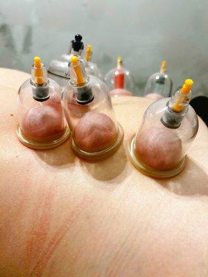 Cupping