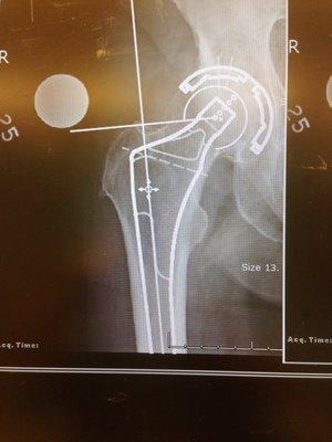 Hip replacement template