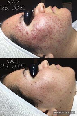 Client came to us with tender, sensitive, and red skin. With the correct acne treatment her redness gradually subsided.