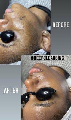 Deep Cleansing facial with dermaplaning at Anso before&after