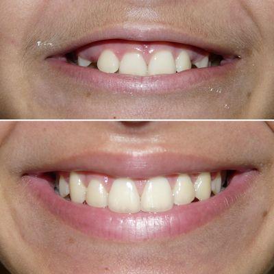 Narrow smile into broad beautiful smile. Adolescent orthodontic treatment.