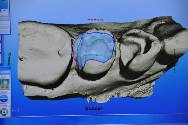 1 appoitment onlays/crowns made with our Cerec machine.  No more going home with temporaries!