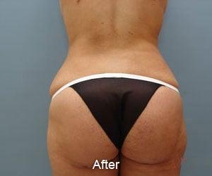 AFTER I LIPO ULTRA PLUS