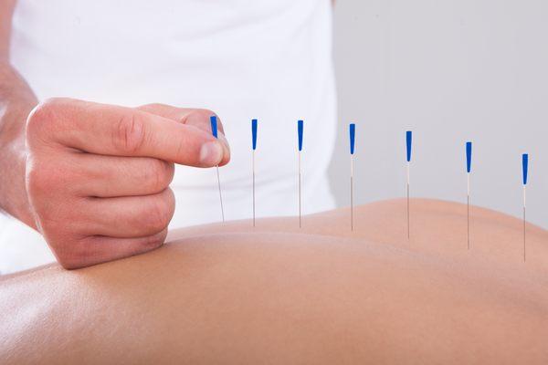 Alternative Care Department, Acupuncture