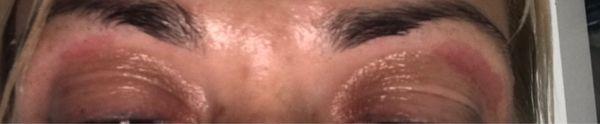 Burned eyelids after eyebrow wax service