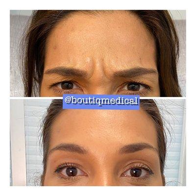 Gorgeous natural Botox results