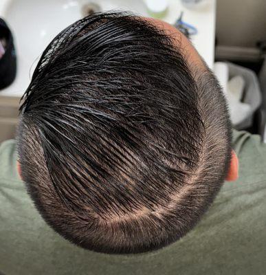 Botched left side of hair line