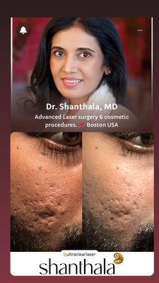 Lasercoring for acne scars in skin of color patients by Dr. Shanthala