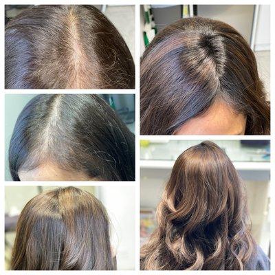 Suffering from an auto immune disease causing hair loss. Hairdreams MicroLines helped her achieve thicker and more voluminous hair.