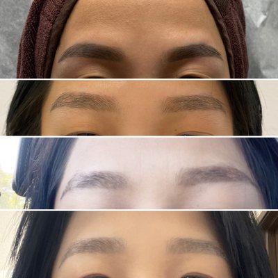 Eyebrow microblading/tatto removal with pico laser