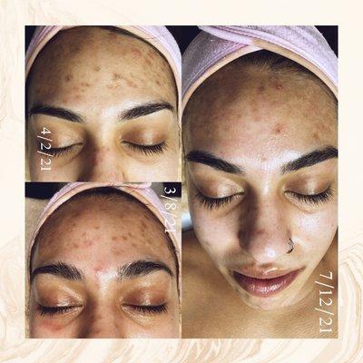 Chemical peel results- acne scarring