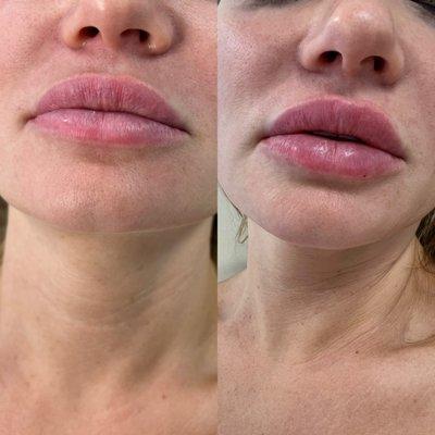 Super model lips using Juvederm Volbella!