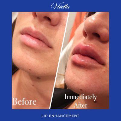 Beautiful lip enhancement!!